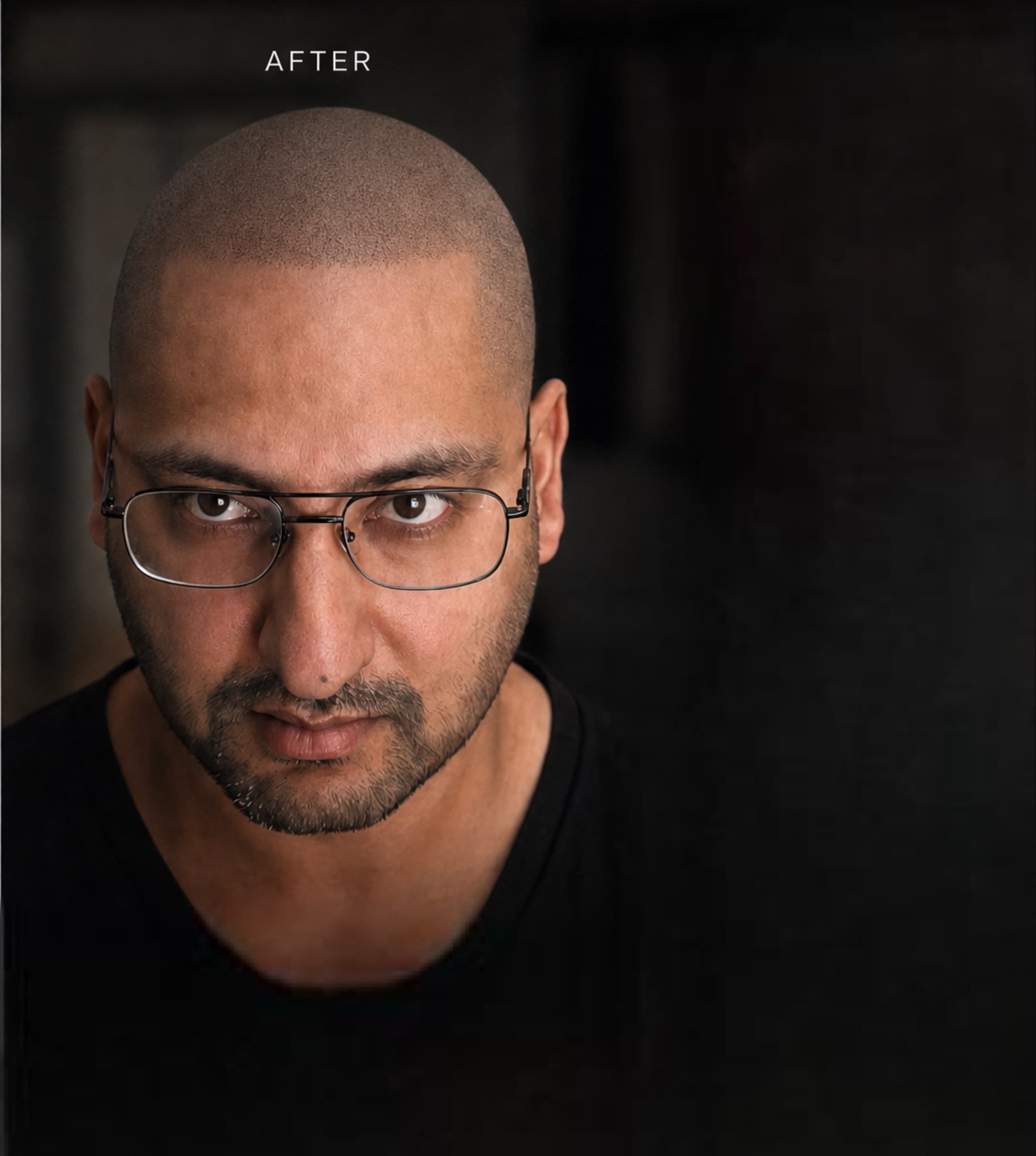 Crown Density — scalp micropigmentation result