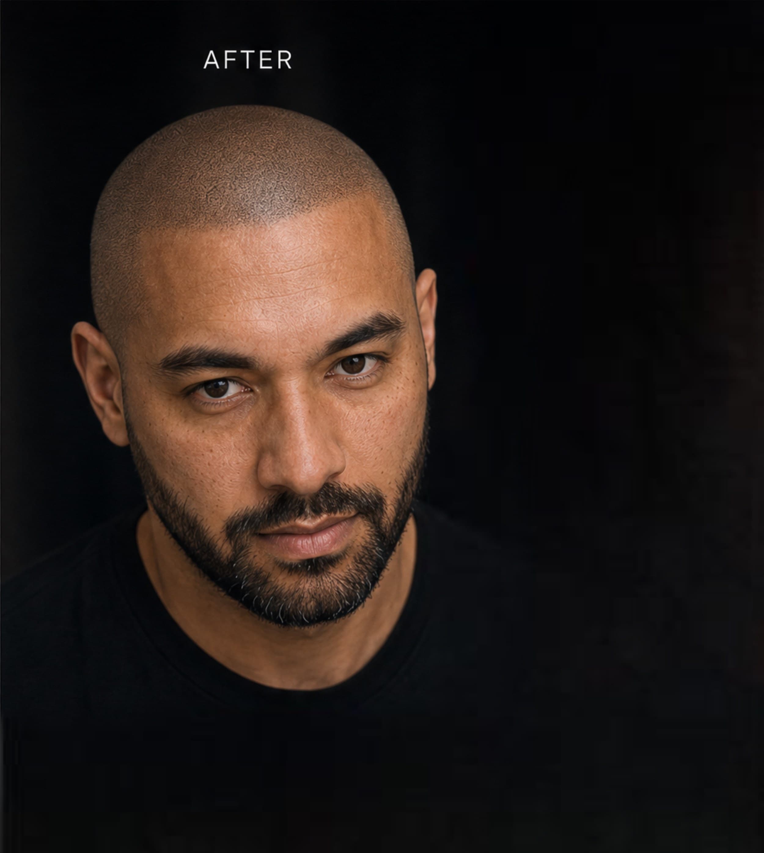 Bad SMP Correction — scalp micropigmentation result