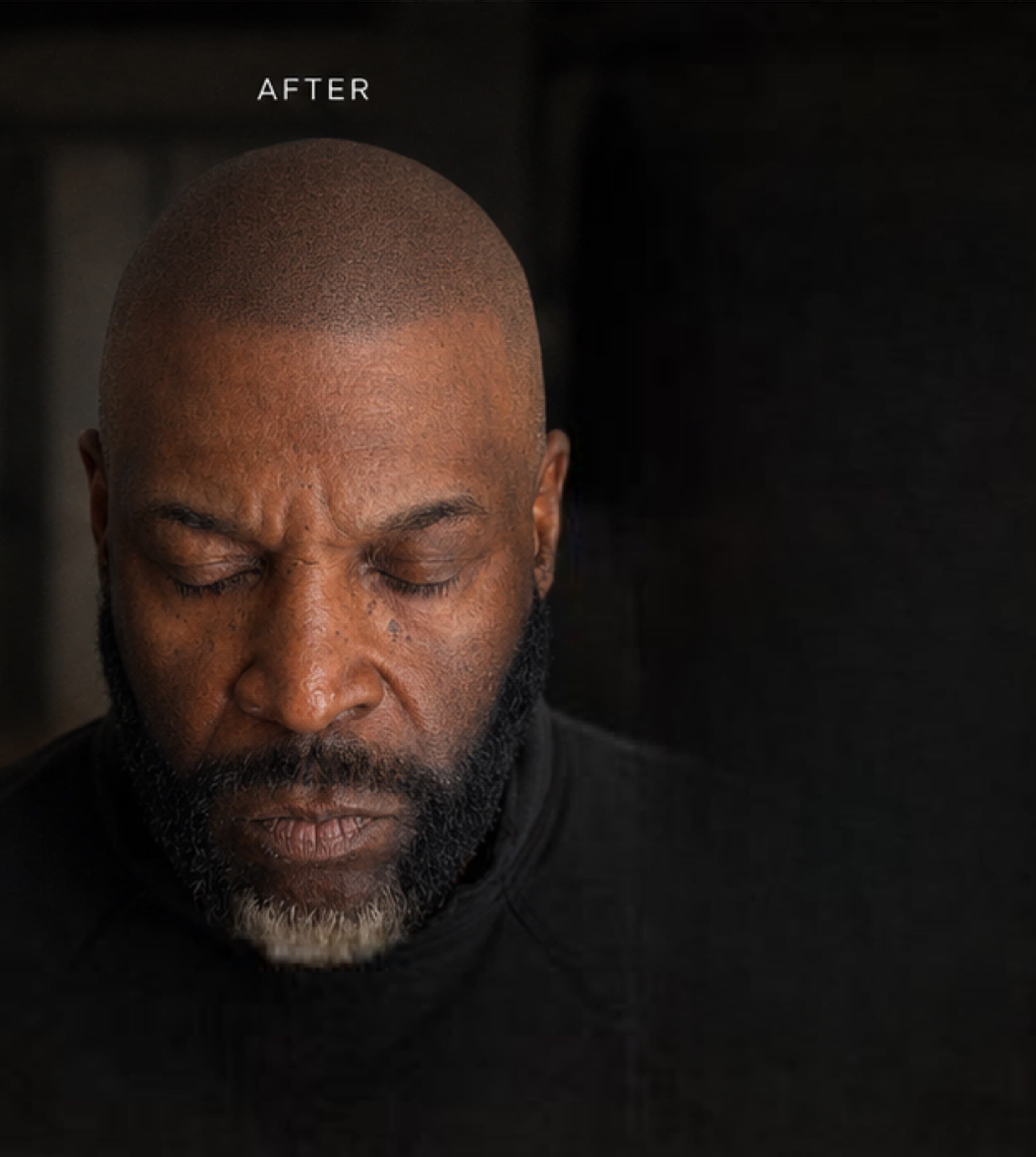 Male Pattern Baldness — after scalp micropigmentation by Joe V. Nguyen, SMPCA San Lorenzo